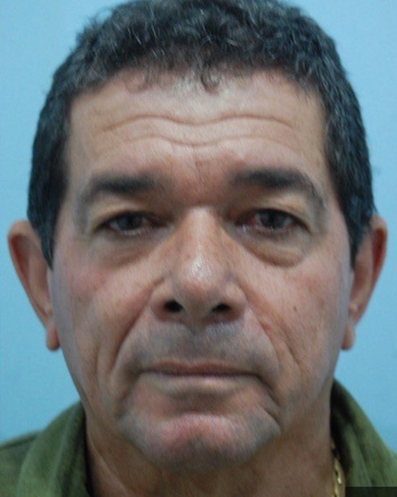 Antes — Fullface + Otoplastia + Blefaroplastia