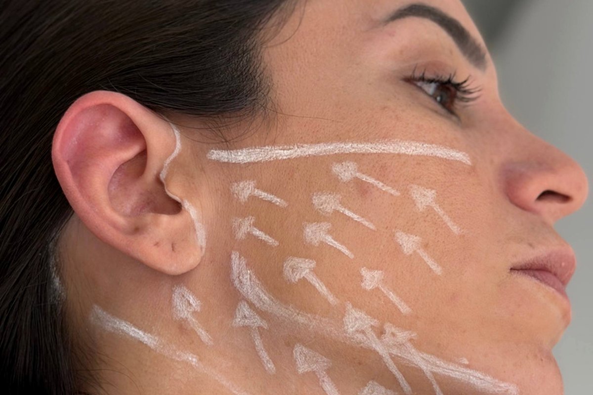 Mini Lift — Dr. Niro Reis