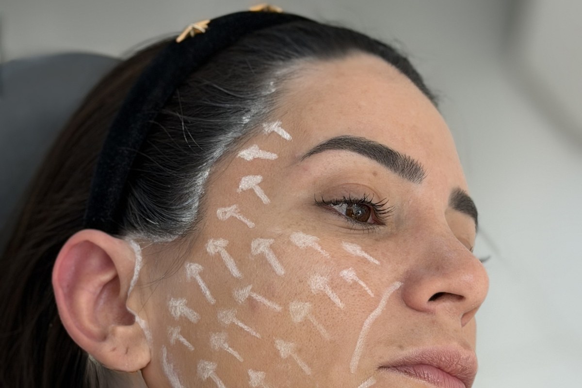 Lift do Terço Médio da Face — Dr. Niro Reis